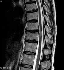 MRI-spine