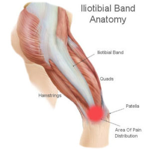 Iliotibial-Band-Syndrome