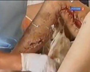 Image (from the article linked above) of the damage caused by injecting the drug.