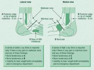 Ottawa-Ankle-Rules