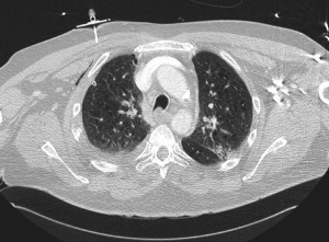 Failed-decompression-pneumothorax