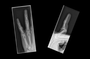 set-finger-bone