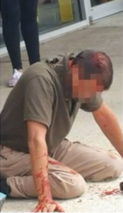 Plain clothes officer after being beaten and pistol whipped by a criminal suspect.