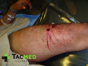 Gunshot-wound-leg-2-300x223