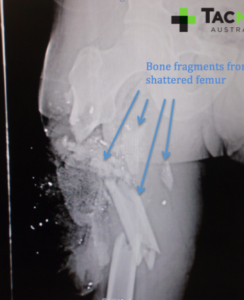 Gunshot-leg-xray-2-350x430